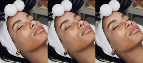 7 Cryotherapy Tools For Fresher-Looking Skin